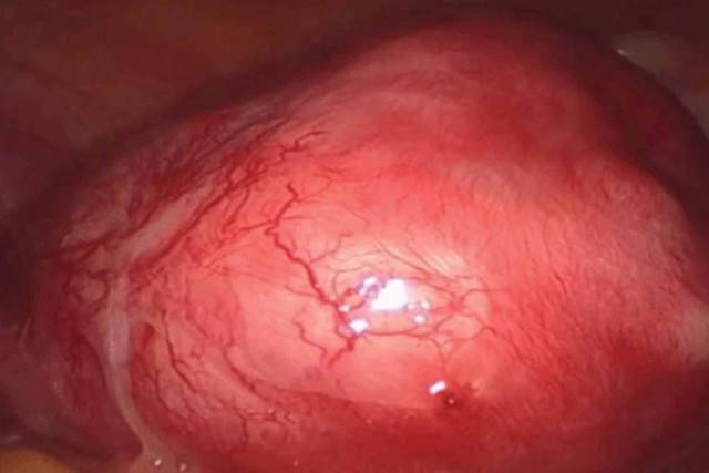 Laparoscopic image of the uterus with adenomyosis.